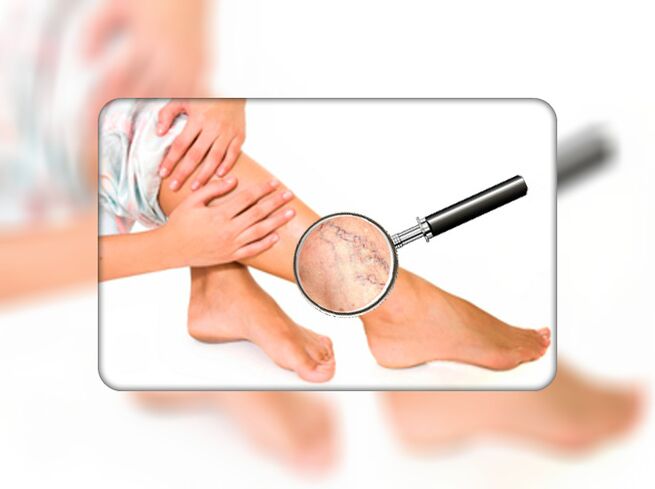 Varicose veins